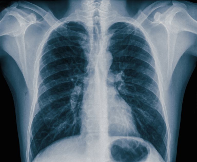 cancro polmone, masse mediastiniche, quest area, linfonodi mediastinici