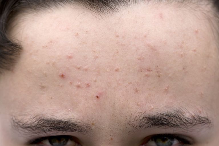 acne moderata, punti neri, potresti avere, acne lieve