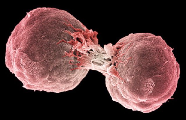questo linfoma, Linfoma cellule, marginale nodale, zona marginale nodale, cellule della, cellule della zona
