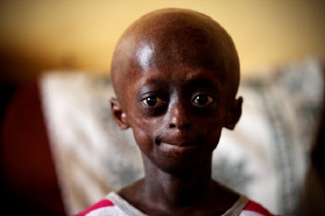 sindrome Werner, bambini progeria, progeria Hutchinson-Gilford, alla progeria, circa milioni