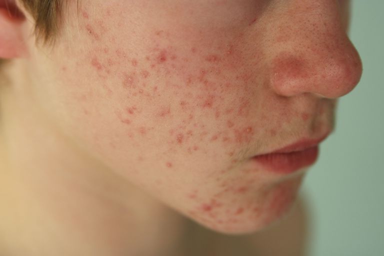 acne rosacea, acne vulgaris, dell acne, della pelle, acne comune