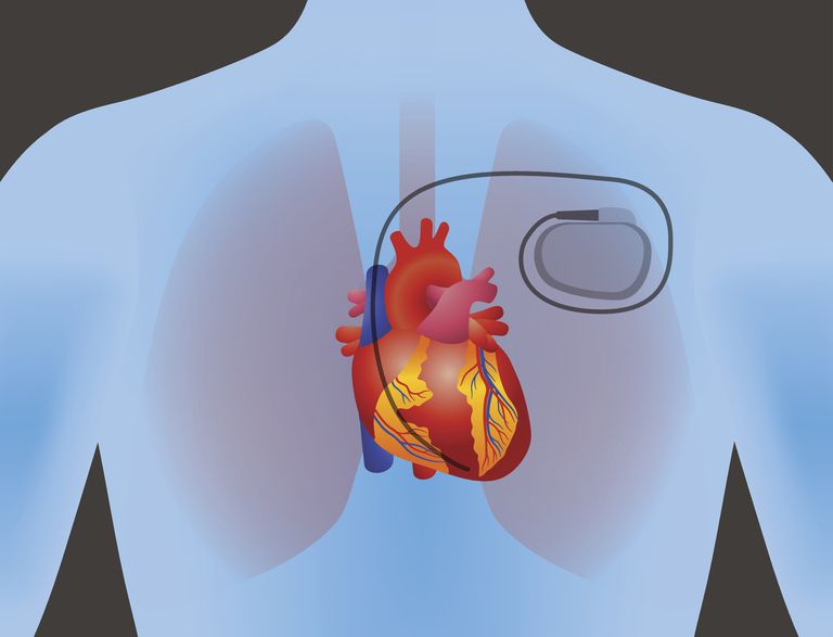 blocco cardiaco, terzo grado, ritmo fuga, secondo grado, blocco cardiaco distale