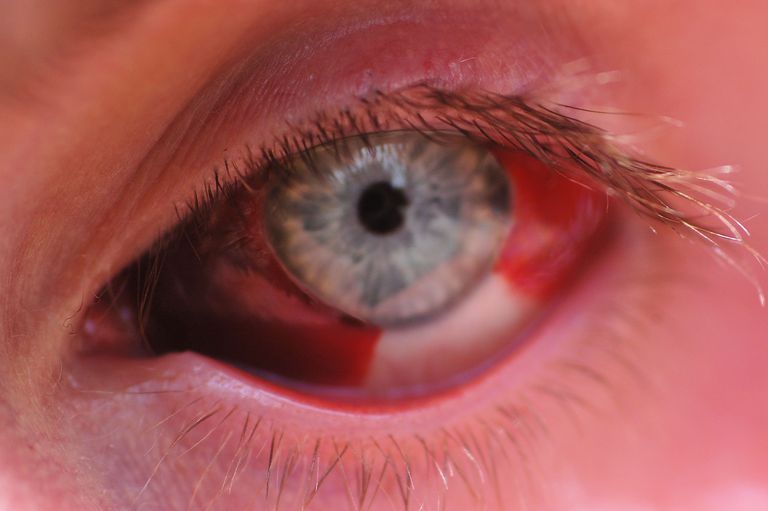 dell occhio, emorragia subcongiuntivale, vasi sanguigni, agli occhi, bianca dell, bianca dell occhio