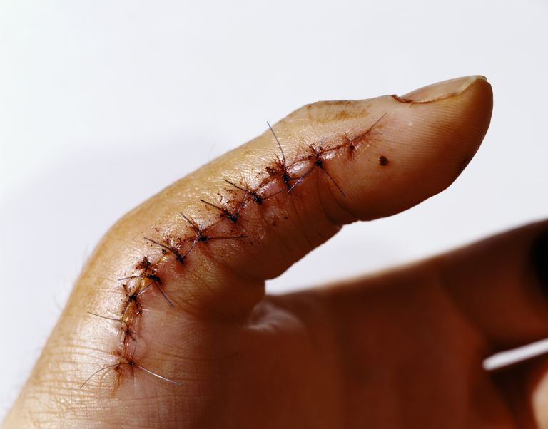 punti sutura, suture sono, Alcune suture, dell incisione, devono essere, durante guarigione