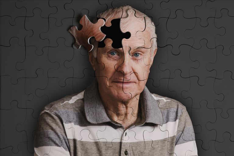 malattia Alzheimer, sensibilità glutine, aumenta rischio, demenza vascolare