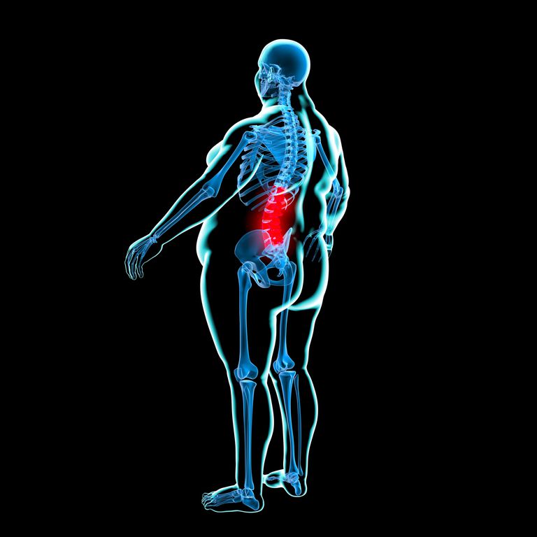 perdita peso, alla schiena, colonna vertebrale, della schiena, attività aerobica, attività fisica